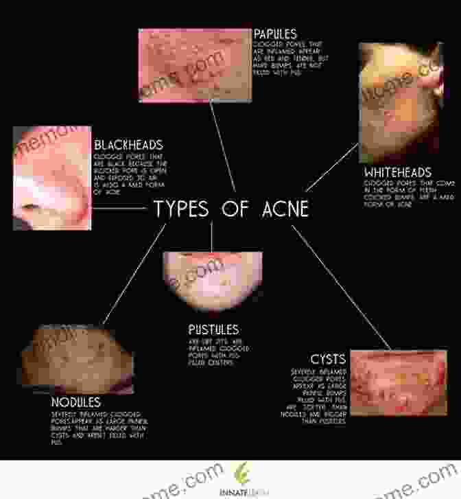 A Diagram Illustrating Various Causes Of Acne, Including Hormonal Imbalances, Clogged Pores, And Bacteria The Acne Cure For Life: The Ultimate Skincare Guide Acne Treatment Diet And Scar Removal (Acne Treatment And Cure)