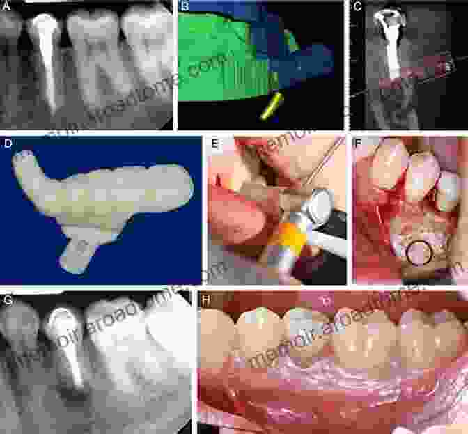 Advanced Endodontic Microsurgery Clinical Cases In Endodontics (Clinical Cases (Dentistry))