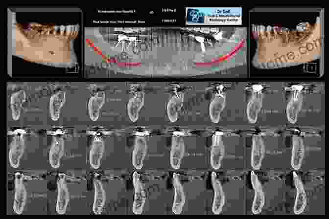 Cone Beam Computed Tomography (CBCT) Image Of A Dental Root Canal System Cone Beam Computed Tomography In Endodontics