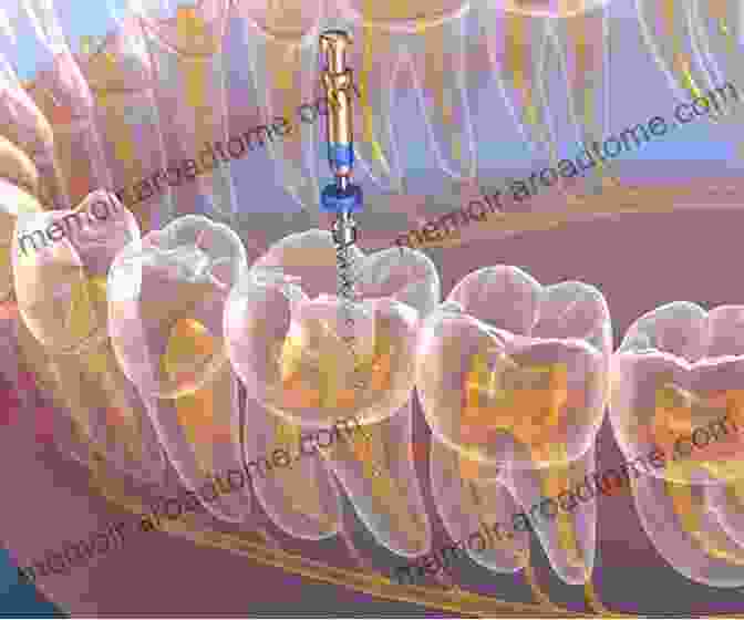 Endodontic Access And Cleaning Clinical Cases In Endodontics (Clinical Cases (Dentistry))