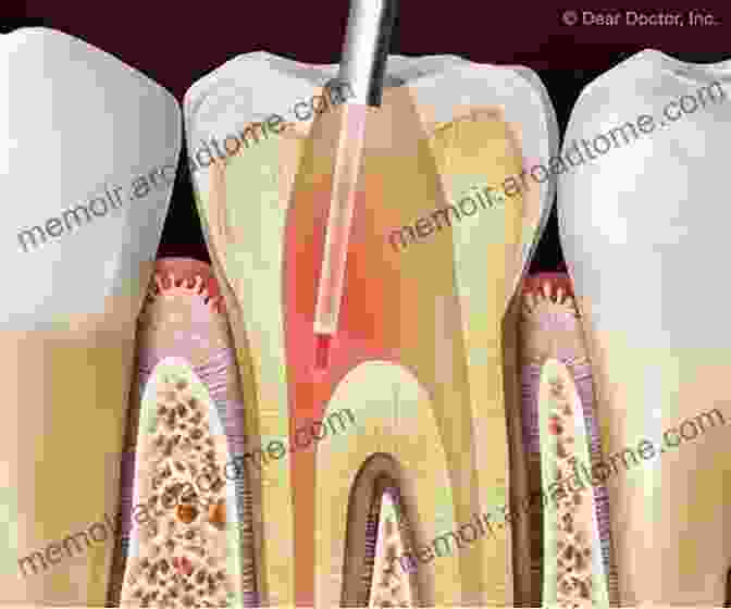 Laser Assisted Endodontic Treatment Providing Precise Cleaning And Disinfection Of The Root Canal System Lasers In Dentistry: Guide For Clinical Practice