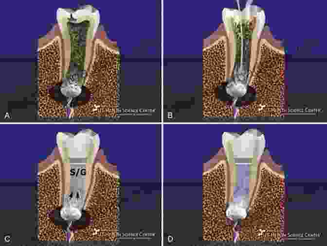 Regenerative Endodontics Procedure Clinical Cases In Endodontics (Clinical Cases (Dentistry))