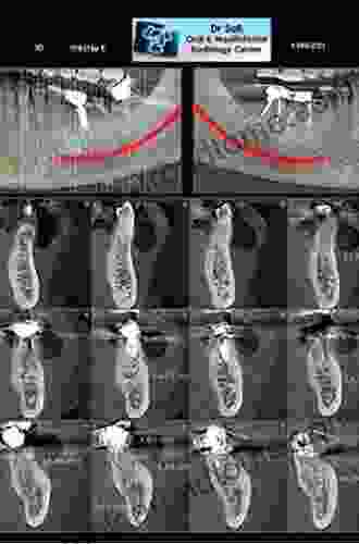 Cone Beam Computed Tomography In Endodontics