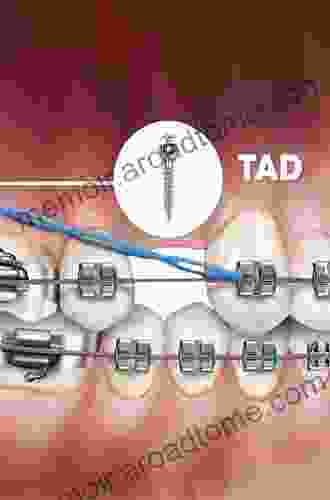 Temporary Anchorage Devices In Clinical Orthodontics